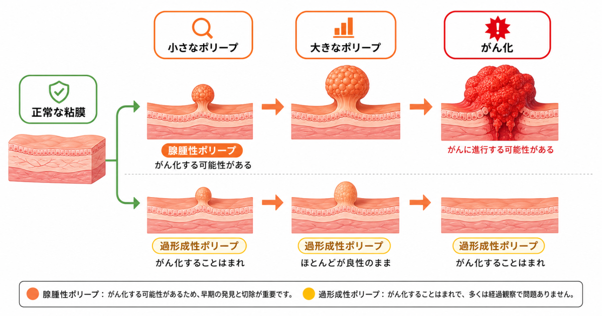 ■大腸ポリープを放置するとどうなる？がん化までの流れ
